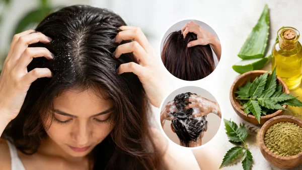 बालों की देखभाल : गर्मियों में बाल झड़ने और खुजली से बचने के लिए रखें स्कैल्प का खास ख्याल