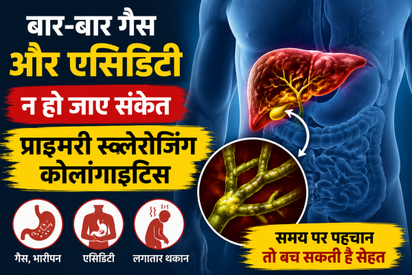 स्क्लेरोजिंग कोलांगाइटिस : लिवर की बीमारी के लक्षण, कारण और बचाव जानिए लिवर की दुर्लभ बीमारी के लक्षण