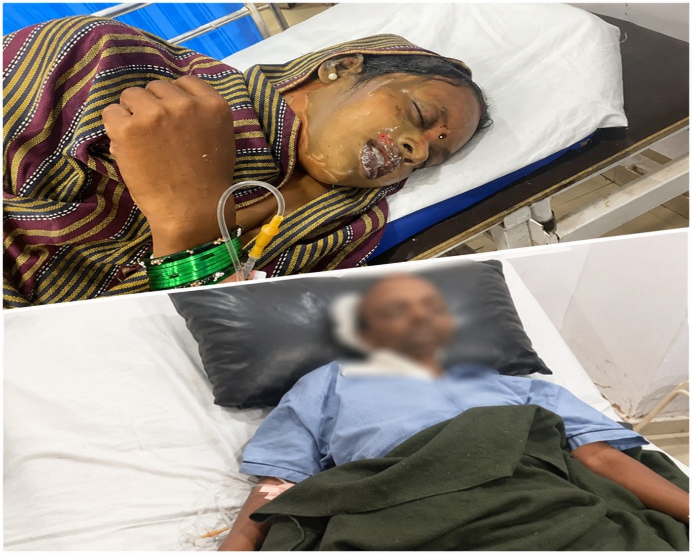 महिला पर एसिड से हमला