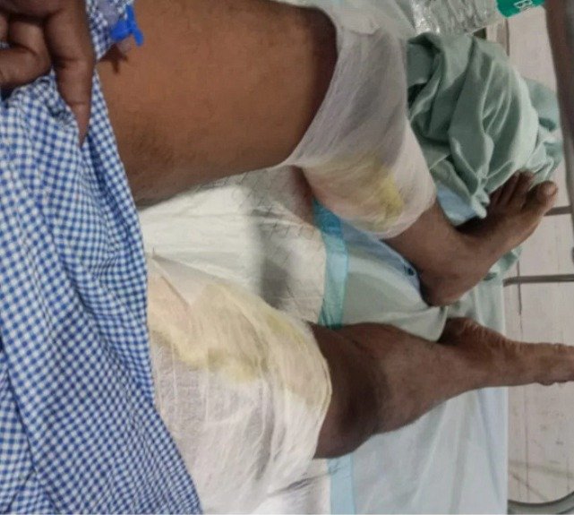 तुमगांव करणी कृपा पावर प्लांट में हादसा, दो श्रमिक घायल